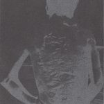 “Hibakusha: Back Skin Neoplasm” - Letterpress - 4x6 - 2013